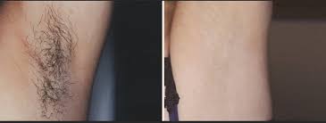 Laser hair removal pricing depends on several factors. Laser Hair Removal Lasers St George Salt Lake City Utah Patel Plastic Surgery