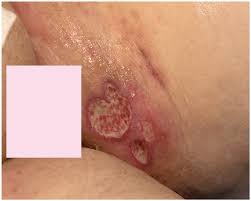 Image result for sore skin in the groin area
