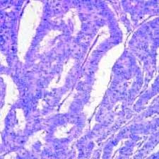 Carcinoid tumors of the midgut (jejunum, ileum, appendix, and cecum). Tejido Tiroideo Con Foliculos Y Foco De Tumor Carcinoide Trabecular Download Scientific Diagram