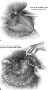 Mar 13, 2015 · enhanced recovery (er) pathways have become the established standard of care in many areas of gastrointestinal (gi) surgery. Technique Of Open Ivor Lewis Esophagectomy Operative Techniques In Thoracic And Cardiovascular Surgery