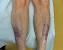 Patchy Leg Hair