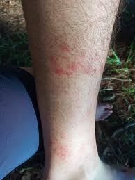 Commonly used as a natural cleaning agent, borax's reported number of successful treatments and health benefits are extensive. How To Cure Heat Rash On Thighs