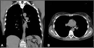Image result for Broncholithiasis