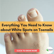 Everything You Need To Know About White Spots On Toenails White Spots On Toenails White Spots On Nails Feet Care