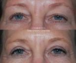 Laser Eyelid Surgery Bellevue, WA - The Stern Center for Aesthetic ...