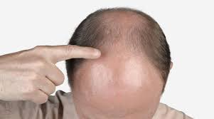 You might get it on your scalp from shampoos or other hair products. Hair Fall In Front Head Medimetry Consult Doctor Online