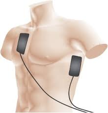 Automated external defibrillators (aeds) and implantable and wearable cardioverter defibrillators (icds and wcds) are devices that restore a normal heartbeat for people in sudden cardiac arrest. Accuracy Of Instructional Diagrams For Automated External Defibrillator Pad Positioning Sciencedirect