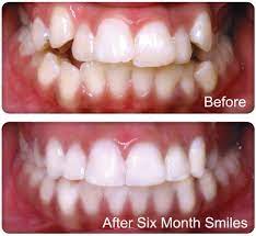 The biggest desire of those who have a misaligned smile is to correct crooked teeth quickly to use, for the shortest possible time, the orthodontic appliance. How To Treat Crooked Teeth Fast 4 Ways With Video Crooked Teeth Cosmetic Braces Clear Braces