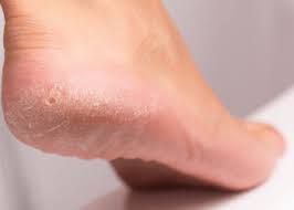 Image result for diabetic toes