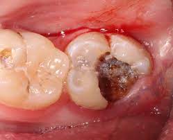 The condition is known as pregnancy gingivitis and if not treated, it can develop to periodontal disease, severe gum infection and gum abscesses. Dental Dilemmas In Pregnancy