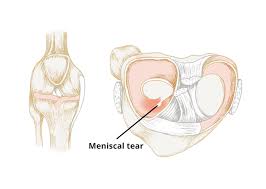 This can further lead to twisting injuries or strain on the other knee, which can lead to injury . Knee Meniscal Tear Circle Integrated Care
