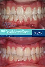 This includes brushing and flossing on a regular basis. Removing White Spots With Icon Mckee Dental Associates
