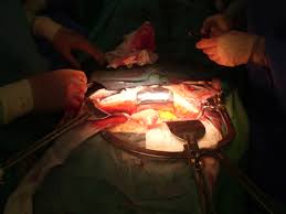 Learn vocabulary, terms and more with flashcards, games and other study tools. Mortalidad En Los Aneurismas De Aorta Abdominal Comparacion Reino Unido Y Eeuu