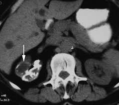 Image result for Genitourinary Tuberculosis