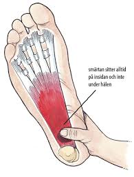 A stabbing pain at the bottom of your foot near your these medications won't cure your plantar fasciitis, but they can make you feel better for a while. Smartande Plantarfascia Halsporre Ortho Center Skane
