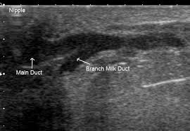 Ultrasound Imaging Of The Lactating Breast Methodology And Application International Breastfeeding Journal Full Text