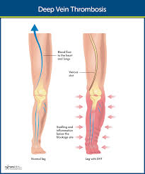 Deep Vein Thrombosis