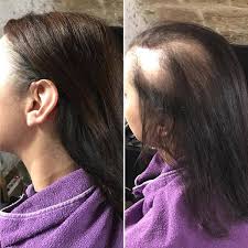 Comprendre la perte des cheveux : Ø¯ÙÙ‚Ø© Ø§Ù„Ø´ÙƒÙ„ Ù…Ø¶Ù„Ù„Ø© Alopecie Femme Kulturazitiste Org