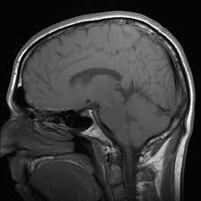 signs symptoms of thalamus brain tumor ehow thalamic stroke stroke symptoms brain aneurysm