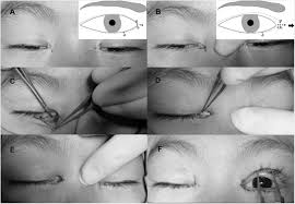 However, variation occurs in the nature of this feature and the possession of 'partial epicanthic folds' or 'slight epicanthic folds' is noted in the relevant literature. Skin Redraping For Correction Of Lower Eyelid Epiblepharon Combined With Medial Epicanthal Fold A Retrospective Analysis Of 286 Asian Children Eye