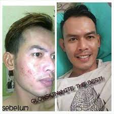 It gets absorbed over this skin within seconds of application, a pleasant hey alekhya, lotus herbal white glow gel creme cannot be used for dark circles, i would suggest you to consult with dermatologist for suitable creme. Testimoni Terbaru Sebulan Glow Skin White Sarawak Facebook