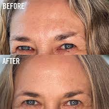 Silicone patches create a slight suction/compression when they're applied over the skin. Sio Beauty Posts Facebook