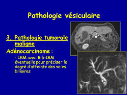 It is not intended to serve as a substitute for professional medical care or a discussion between you and your surgeon about the need for a surgery. Imagerie Des Voies Biliaires Ppt Video Online Telecharger