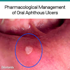 Image result for Aphthasol