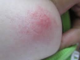 If the cancer is limited to the breast, 96% of patients will be alive five years after. Inflammatory Breast Cancer Australia Pdf Ppt Case Reports Symptoms Treatment