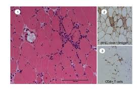 Image result for Polymyositis