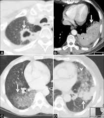 Find out about having the scan, what happens and and how you might feel afterwards. Lung Cancer Ct Wikidoc