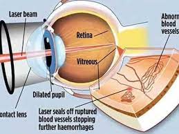 Lasik Eye Surgery Risks Lasik Eye Surgery Risks And Complications Lasik Eye Surgery Laser Eye Surgery Eye Surgery