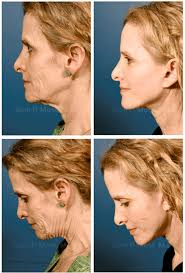 One suggested hair style is the high ponytail. The Truth Behind Facelift Myths The Pmfa Journal