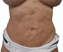 Fibrosis post liposucción - Dr. Diego Sturletti - Mejor Cirugía Plástica en Madrid