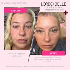 THE VIRAL REGENPEN™