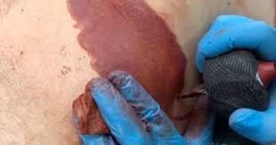 Nevus)‏ هو مصطلح طبي لعلامة خِلقية مرئية على الجلد أو الغشاء المخاطي. Ø£Ø¨ ÙƒÙ†Ø¯Ù‰ ÙŠØ±Ø³Ù… Ù†Ø³Ø®Ø© Ø·Ø¨Ù‚ Ø§Ù„Ø£ØµÙ„ Ù…Ù† ÙˆØ­Ù…Ø© Ø¹Ù„Ù‰ Ø¬Ø³Ù… Ø§Ø¨Ù†Ù‡ ÙÙŠØ¯ÙŠÙˆ ÙˆØµÙˆØ± Ù†ÙŠÙˆØ² ÙÙˆØ± Ù…ÙŠ