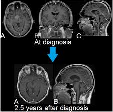 Cancer gives most people no symptoms or signs that exclusively indicate the disease. Frontiers Atypical Teratoid Rhabdoid Tumor Two Case Reports And An Analysis Of Adult Cases With Implications For Pathophysiology And Treatment Neurology