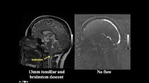 Why do mri scans take so long? Mri Magnetic Resonance Imaging Mayfield Brain Spine Cincinnati Ohio