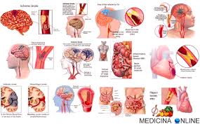 Si ha una emorragia cerebrale in. Ictus Sintomi Cause Inoltre Conseguenze Ictus Danni Permanenti