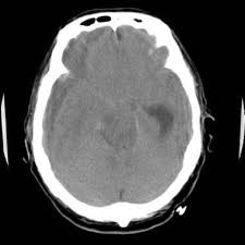 Image result for CT Head