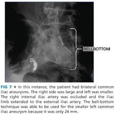 We did not find results for: Advanced Aneurysm Management Techniques Management Of Internal Iliac Aneurysm Disease Thoracic Key