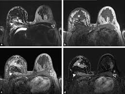 A ct scan (also called a cat scan or computed tomography scan) can help doctors find cancer and show things like a tumor's shape and size. Would A Pet Scan Detect Breast Cancer