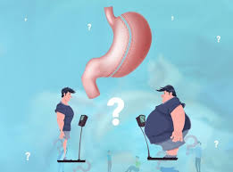 Gibt Es Irgendwelche Risiken Einer Schlauchmagen Operation Dr He Obesity Clinic