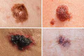 Some types of skin cancer are more dangerous than others, but if you have a spot. A Better Way To Distinguish Among Melanomas