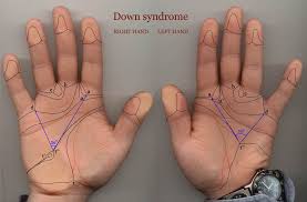 Some individuals with down syndrome have just one crease across their palm, called the transverse palmar crease. Pin On Cute Babies