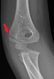 Image result for Lateral Condyle Fracture