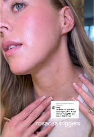 Rosacea Skin Care: Tips for Acne Prone Skin