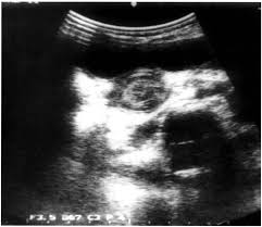 We did not find results for: Ileoileal Intussusception A Report Of Four Cases Annals Of Saudi Medicine