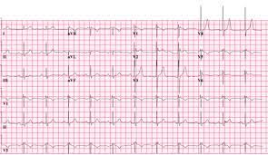 Brugada Syndrome Wikipedia