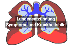 Lungenentzundung Symptome Verlauf Therapie Praktischarzt